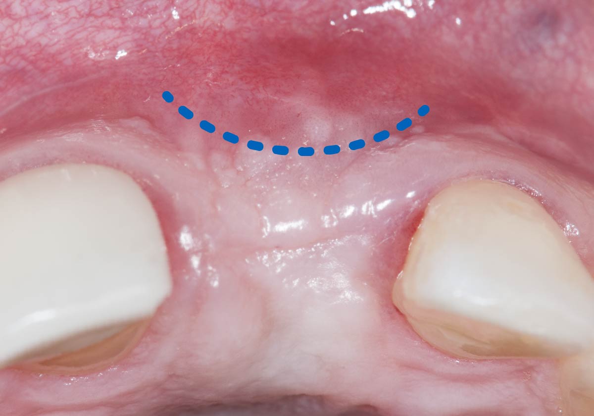 Loose gum tissue patient procedure step 1
