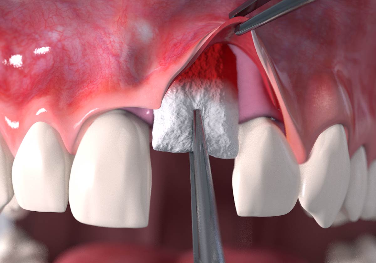 Loose gum tissue surgical procedure step 3