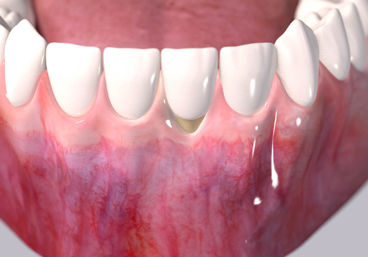 Receding gums surgical procedure step 1