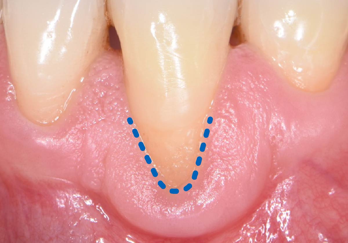 Receding gum tissue patient procedure step 1