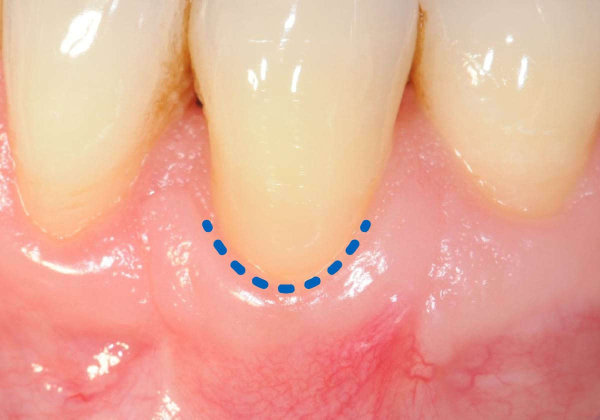 Receding gum tissue patient procedure step 2